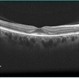 Plaquenil Toxicity